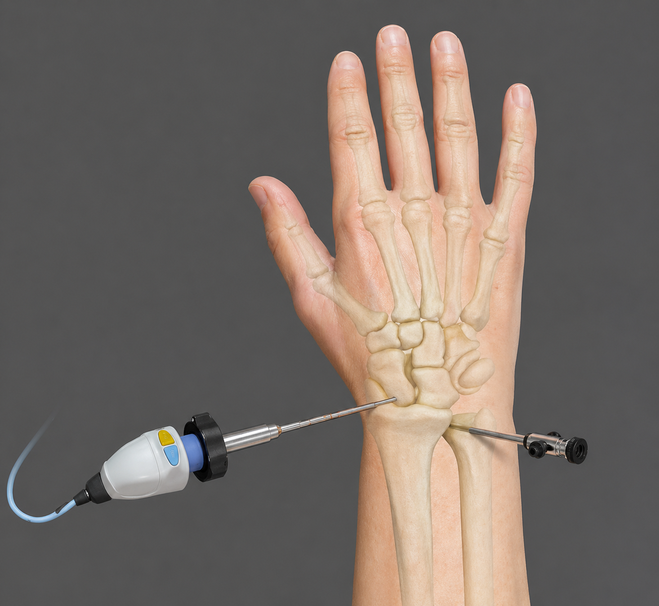 Wrist Arthroscopy